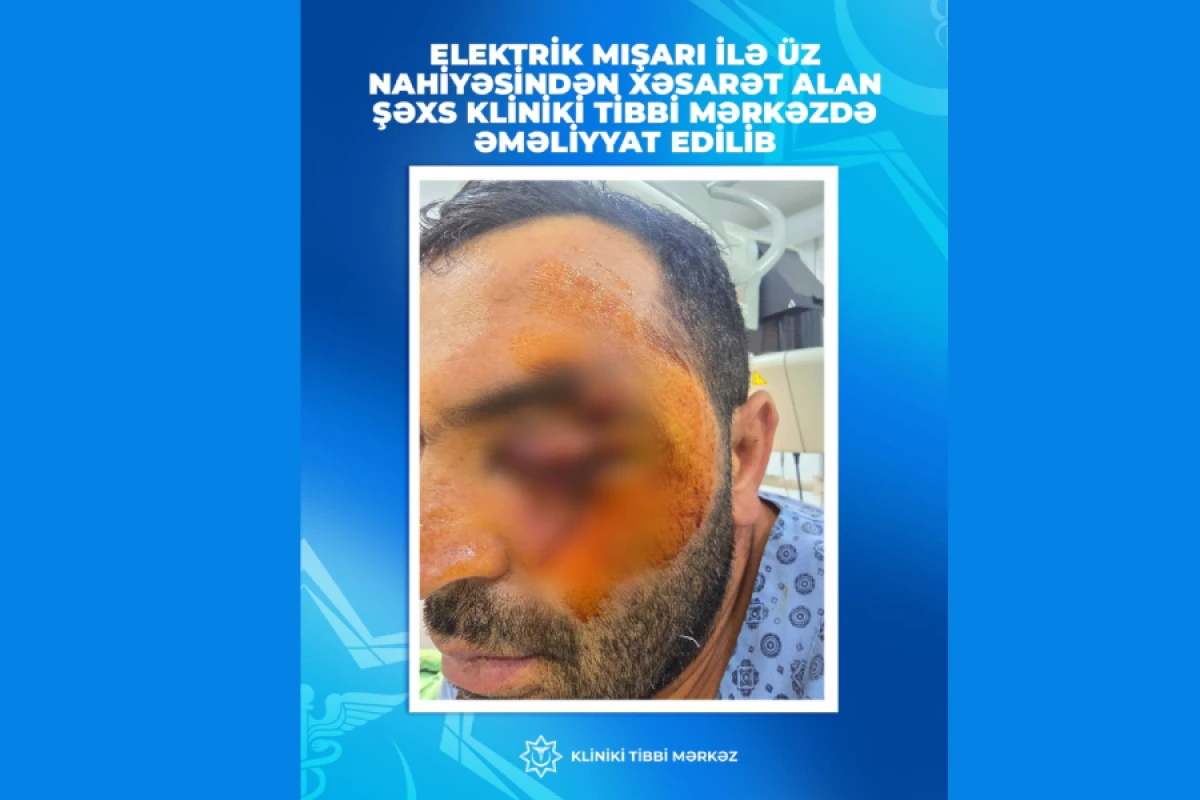 Üzünü elektrik mişarı ilə kəsmişdi, [[əməliyyat edildi]]