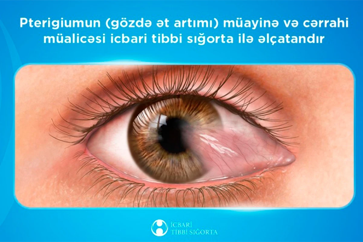 Gözdə ət artımı üzrə icra olunan [[əməliyyatların sayı]] açıqlandı