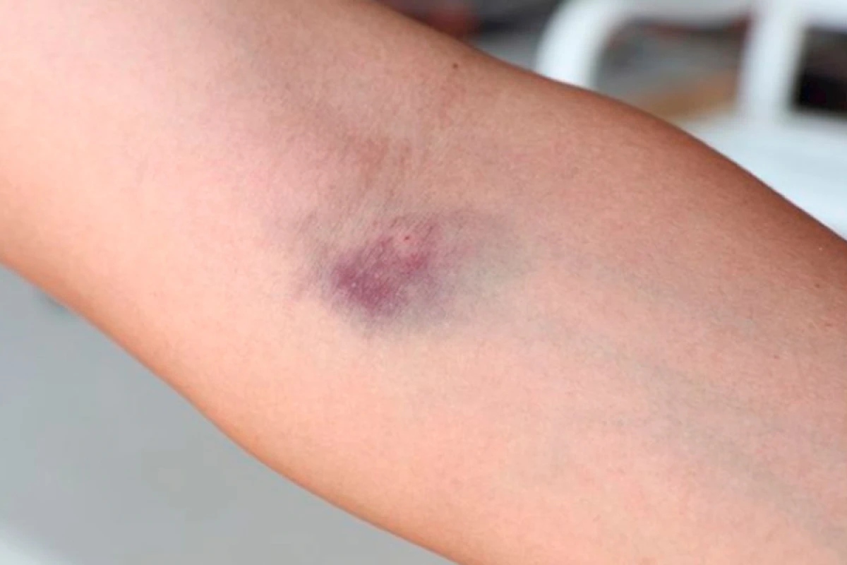 Qanvermədən sonra qolda [[ağrı və göyərmə]] niyə yaranır?