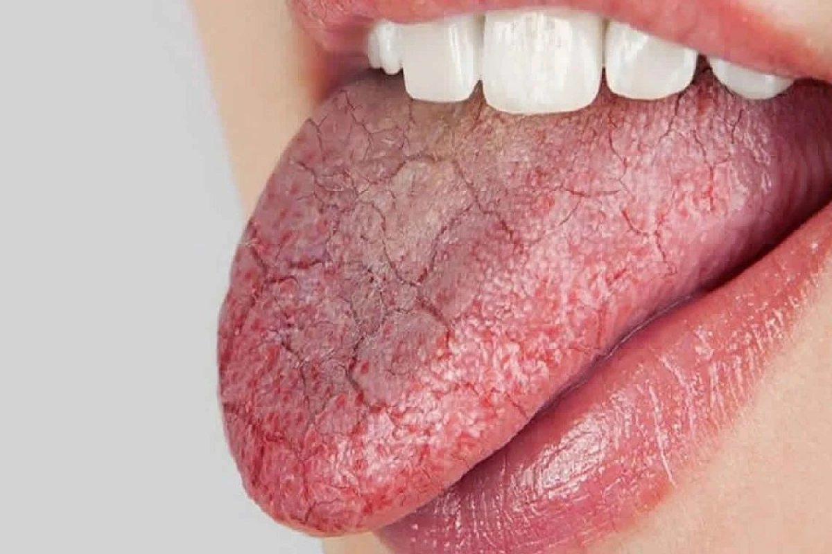 Dildə [[ləkələr]] niyə yaranır?