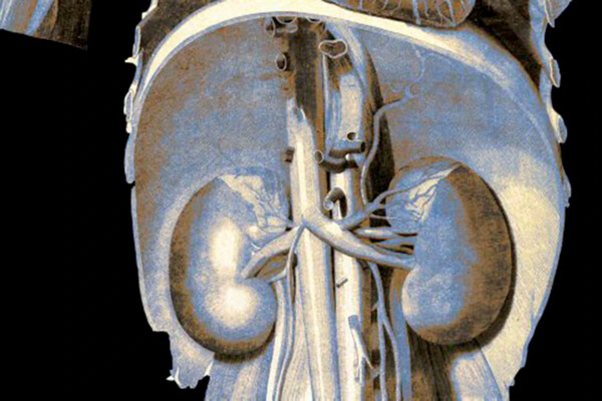 [[Alimlər:]] Diş əti xəstəlikləri böyrəklərə zərər verə bilər