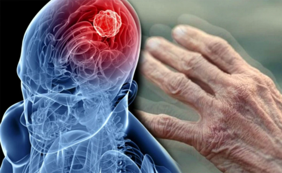 [[Parkinson]] xəstəliyinin ilk əlamətləri hansılardır?