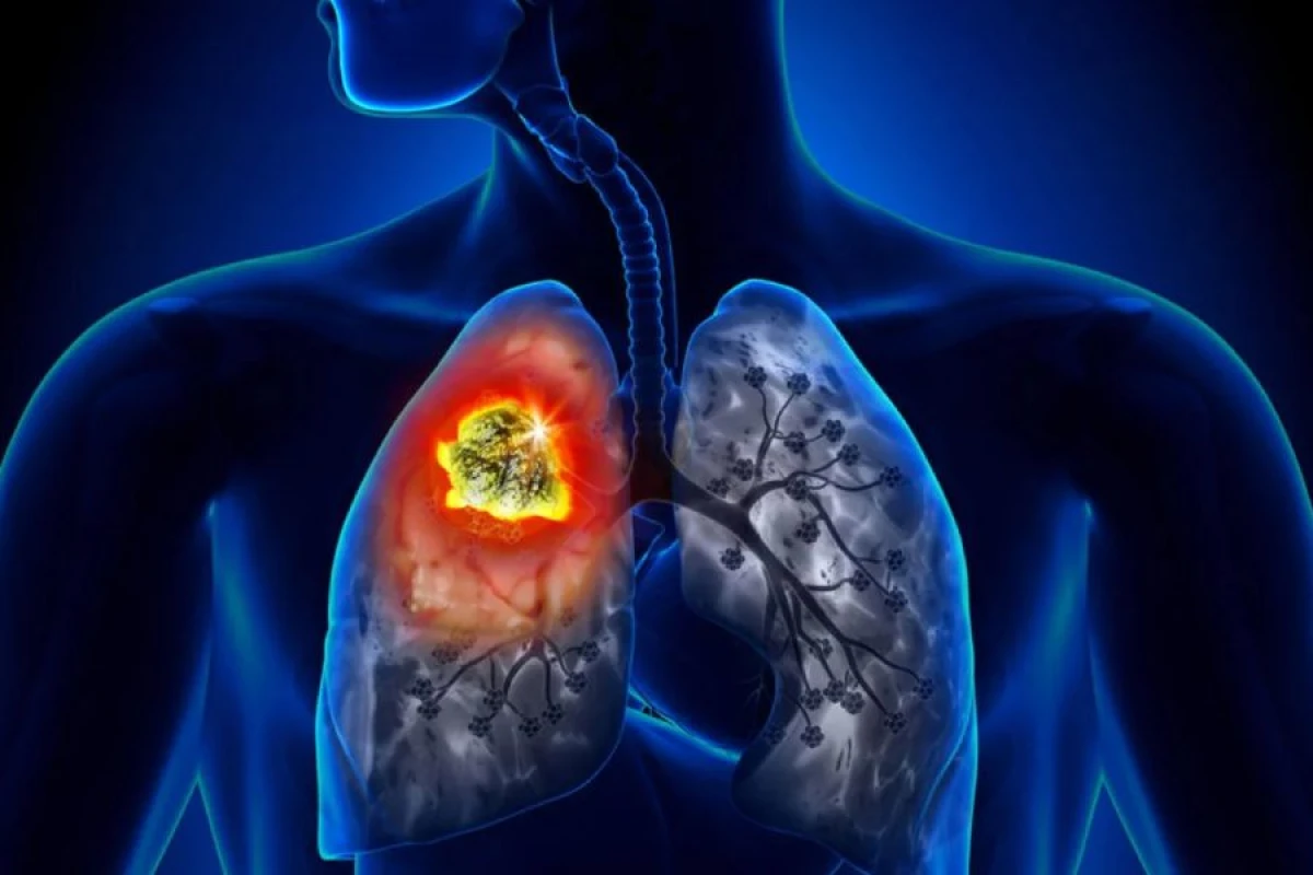 Ağciyər xərçəngi “kimliyini” dəyişə bilər [[– YENİ ARAŞDIRMA]]