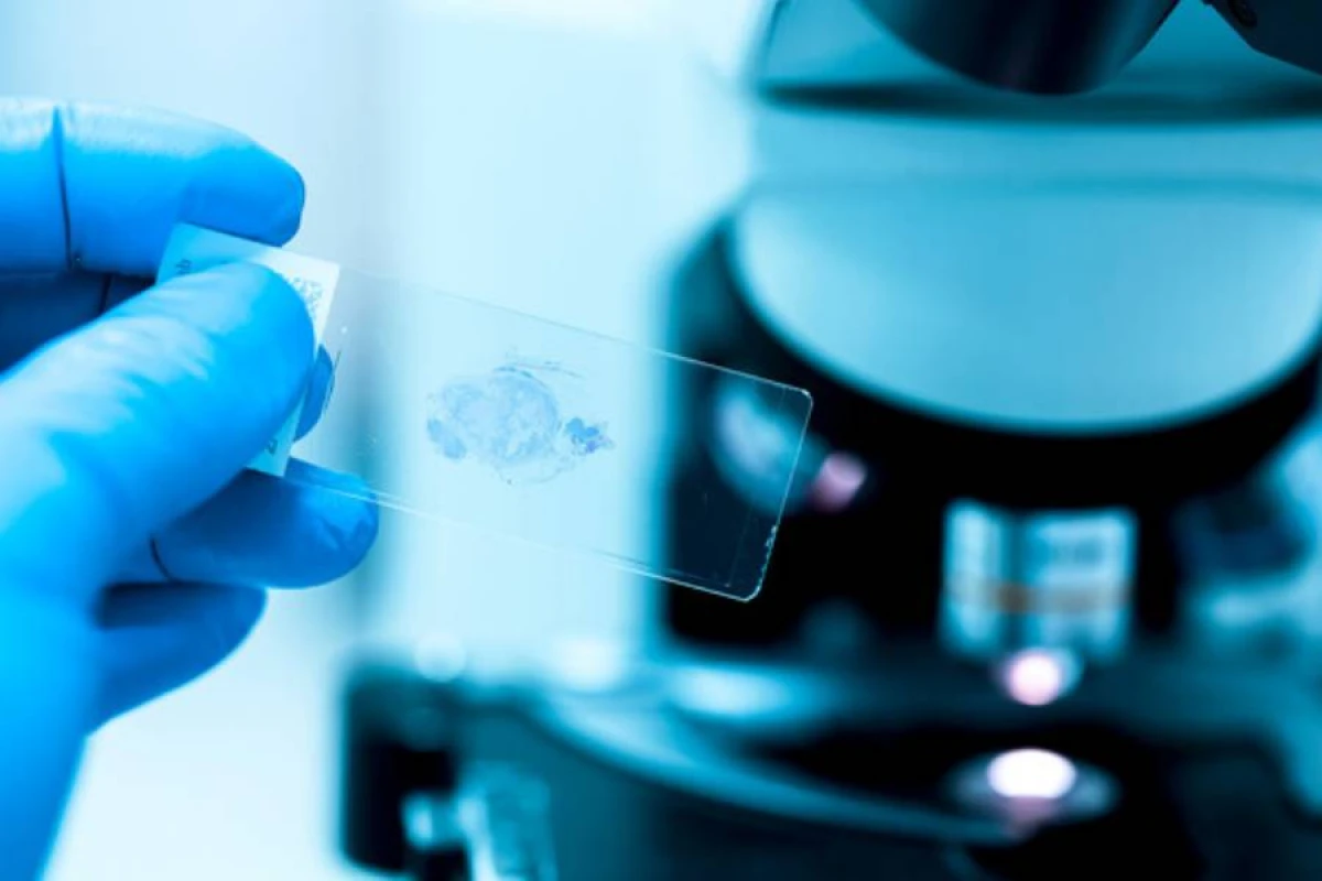 Şiş toxumasının sıxlığı xərçəngin yayılmasını [[sürətləndirə bilər]]