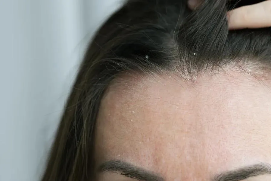 Seboreik dermatit zamanı nə etməli? - Əlamətlər və təbii dəstək yolları